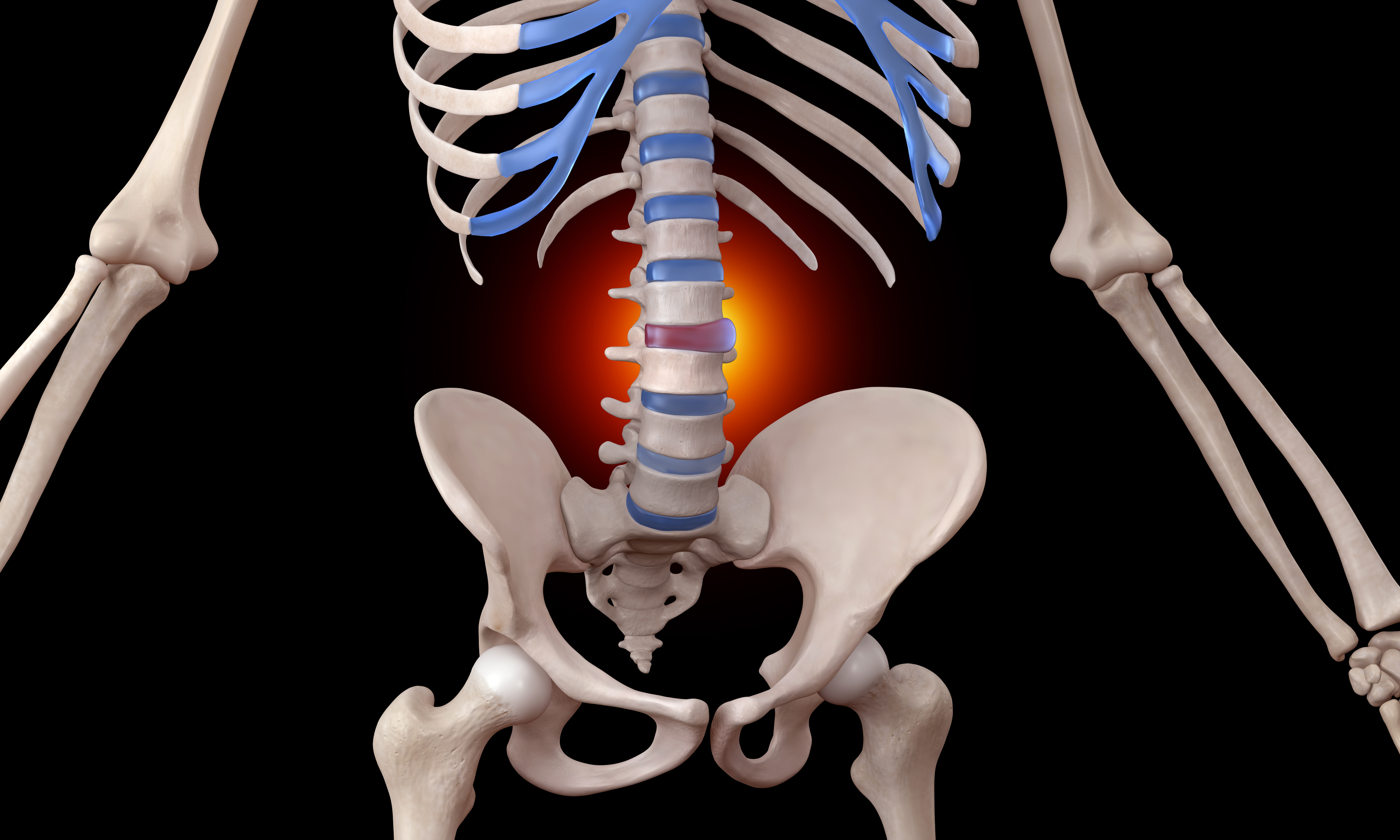 3D illustration of a disc bulge and herniation in the spine
